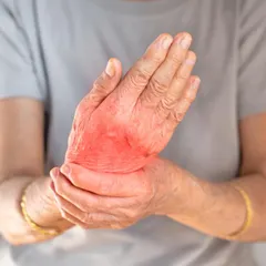 Rheumatoid Arthritis is an autoimmune condition that I treat by focusing on detoxification and pacifying Vata and 'ama' (toxins). Panchakarma therapies like Virechana (purgation) and medicated oil massages help reduce inflammation and rebuild strength in the joints over time.