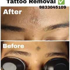A before-and-after look at a forehead spot removal. The 'after' shows the skin healing after the laser treatment has broken down the pigment.