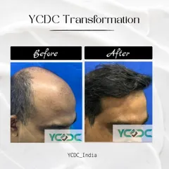 This side-profile transformation showcases the restoration of the hairline and temporal points. A natural-looking hairline is crucial for a successful hair transplant.