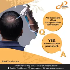 A common question I get is whether hair transplant results are permanent. The answer is yes. The Follicular Unit Extraction (FUE) procedure we perform provides a permanent hair regrowth solution, giving you a completely natural look.