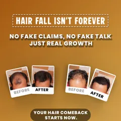 Hair fall doesn't have to be your final story. These before and after photos showcase the real growth my clients achieve. We focus on USFDA-approved solutions that deliver a genuine comeback for your hair.