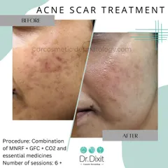 This before and after image shows the real transformation possible for acne scars. Using a personalized combination of Microneedling Radiofrequency (MNRF), GFC, CO2 laser, and specific medicines over several sessions, we achieved a significant reduction in scar depth and a much smoother skin texture.