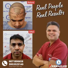 After 11 months, this client's 3000-graft hair transplant has yielded incredible results. The 'before' photo shows the pre-operative markings for hairline design, and the 'after' photo displays the full, natural-looking outcome.