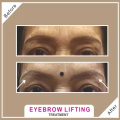 An instant lift for tired-looking eyes. This before and after shows the subtle but effective results of a non-surgical eyebrow lifting treatment, which helps to open up the eye area for a more refreshed and youthful appearance.
