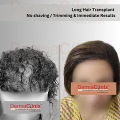This image shows the immediate, transformative result of a Long Hair FUE procedure for a female patient. The ability to perform the transplant without shaving is a significant advantage, ensuring privacy and comfort.