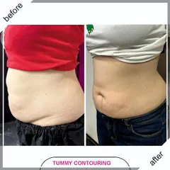 This is the result of our Tummy Contouring program after just one session of Cristal Pro. We focus on reducing stubborn belly fat and tightening the skin, helping our clients feel more confident and comfortable.