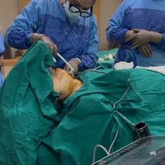 Here I am performing a FaceTite procedure, which uses radiofrequency energy to contour the lower face and reduce a double chin. This minimally invasive treatment provides significant tightening results.
