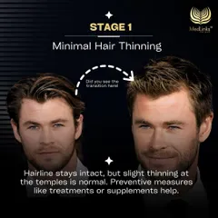 Stage 1 of hair loss is minimal thinning, often at the temples. At this point, the hairline is still intact, and preventive measures like supplements and treatments can be very effective.