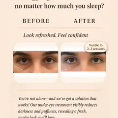 Tired of looking tired? Our under-eye treatment visibly reduces darkness and puffiness. This before and after shows a refreshed, more awake appearance after just a few sessions.