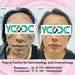 This patient came to me after an improper treatment elsewhere left her with facial burns. This before and after shows the significant progress made in clearing the deep pigmentation and restoring her skin's health.