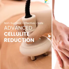 This is a close-up of our advanced cellulite reduction technology at work. The device is non-surgical and safely targets the underlying structures that cause dimpling, helping to smooth and firm the skin.
