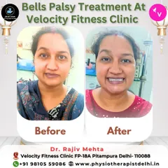 This is one of the most rewarding parts of my work. This patient came to me for Bell's Palsy treatment, and this before and after image shows the incredible progress we made together, restoring her smile and facial control.
