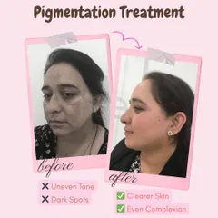 This client's journey shows a significant reduction in dark spots and uneven tone. Our pigmentation treatments work to create a clearer, more even complexion you can feel proud of.