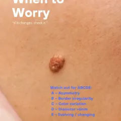 The ABCDEs are a simple guide to know when to worry about a mole. If you notice Asymmetry, Border irregularity, Color variation, a Diameter over 6mm, or any Evolution, it is time to get it checked.