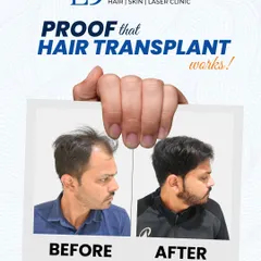 This is the kind of result that ends all doubt. Using my RT-FUE hair transplant technique, I achieved a full, natural density for this patient. The planning focused on creating a hairline that blends seamlessly for long-term, lasting growth.