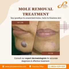 This is a clear example of a successful mole removal. Using a safe and effective technique, I was able to remove the unwanted mole from the chin area, leaving behind clear skin. The procedure is quick and the results are permanent.