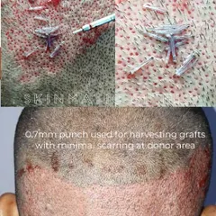 Our technique is built on precision. We use a 0.7mm punch to harvest hair grafts, which is a key reason our FUE procedure results in minimal scarring and faster healing for the donor area on the scalp.