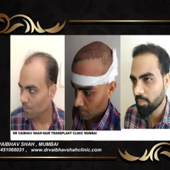 This collage provides a clear look at the different stages. The middle photo shows the precision of the graft placement during the DHI procedure.