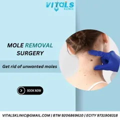 An informational graphic explaining mole removal surgery. I offer this procedure to address unwanted moles, using either laser or surgical excision methods depending on the mole's characteristics.