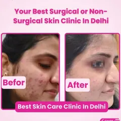 A clear example of how targeted treatments can tackle both active acne and the redness it leaves behind. The 'after' photo shows a significant reduction in inflammation and a much calmer, clearer complexion.