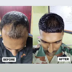 We are proud to serve clients from all walks of life. This shows the 5-month progress for a member of the armed forces, demonstrating significant new growth and coverage after his FUE procedure.