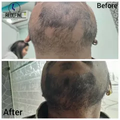 Alopecia doesn't just affect the scalp. This client had patchy hair loss in his beard. Our treatment successfully stimulated regrowth, resulting in a full and even beard.