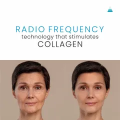 Thermage is a powerful non-surgical treatment that uses radiofrequency technology to stimulate collagen. This before-and-after shows the visible skin lifting and tightening effect after just one session.