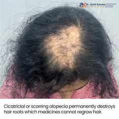 This image explains that cicatricial or scarring alopecia permanently destroys hair roots, which means medication alone cannot regrow hair. A hair transplant is the only viable option for restoration in such cases.
