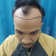 The first step is designing a natural hairline. Here you can see the pre-operative markings that guide the entire transplant procedure, tailored to the patient's facial structure.