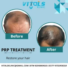 This before and after image showcases the results of PRP treatment for a patient with significant hair thinning on the crown. The 'after' photo shows a noticeable increase in hair coverage and density, demonstrating the restorative power of this regenerative therapy.