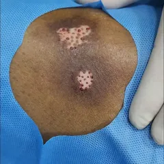 This image shows the immediate result of a mini punch grafting procedure for vitiligo. Small grafts of pigmented skin are transplanted into the white patches. This method is particularly effective for treating both small and large areas of stable vitiligo and kickstarts the repigmentation process.