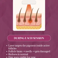 During each laser session, the laser beam's energy is absorbed by the pigment in the hair follicle. This generates heat that damages the follicle, slowing its ability to regrow hair. A slight redness is a normal and temporary reaction, indicating the treatment is working effectively.