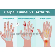 Is it carpal tunnel or arthritis? This visual guide helps differentiate between osteoarthritis, rheumatoid arthritis, and carpal tunnel syndrome by showing how each condition typically affects the joints and nerves in the hand and wrist.