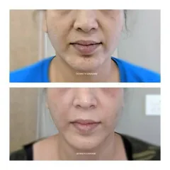 This before-and-after demonstrates a subtle liquid facelift effect. By adding volume with dermal fillers to key areas like the cheeks and softening smile lines, the entire mid-face appears lifted and more youthful.