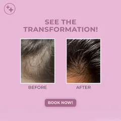 The transformation is clear. This result was achieved through our advanced GFC/PRP treatment combined with a derma pen, which enhances the delivery of growth factors to the hair roots for improved hair revival.