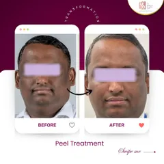 Real results speak for themselves. This is a transformation achieved with a customized chemical peel treatment plan designed to address specific skin concerns, revealing a brighter, more even-toned complexion underneath.
