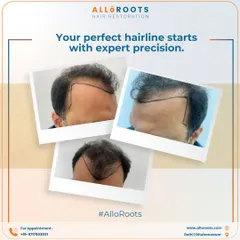 A successful hair transplant is built on a foundation of expert precision and detailed planning. These images show how I map out the recipient areas to create a natural-looking hairline and ensure optimal density, which is the first step toward achieving a flawless result.