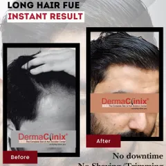 This is our Long Hair FUE technique, which we call Instagraft. It allows for a complete hair transplant with absolutely no shaving or trimming and zero downtime. The patient walks out with instant coverage, making it a discreet and convenient option.