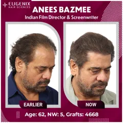 A complete view of Director Anees Bazmee's transformation from all angles, showing the density and natural hairline we created.