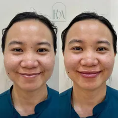 A full-face view of a subtle lip filler transformation. The goal was to enhance her natural beauty by balancing her features and adding a touch of hydration to the lips, resulting in an overall refreshed look.