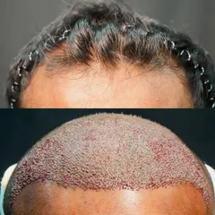 This image shows the immediate result of a 4600-graft FUE procedure. The 'before' shows a receded hairline, and the 'after' displays the newly created hairline with densely packed grafts on day zero.
