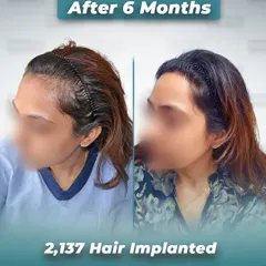 A side-profile view of a female client 6 months after her no-shave hair transplant. We implanted 2,137 hairs to restore her hairline, achieving a natural and beautiful result with zero downtime.