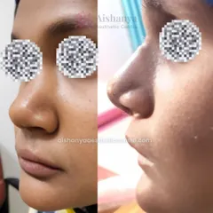 A well-proportioned nose can bring harmony to the entire face. This before-and-after image shows a rhinoplasty result where the nose has been refined to better suit the patient's facial features, creating a balanced and natural profile.
