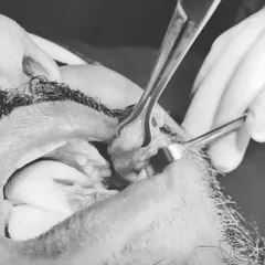 This clinical image shows the buccal fat pad being removed through a small incision inside the mouth. This procedure, known as buccal fat excision, is designed to reduce cheek fullness and create a slimmer, more chiseled facial appearance.