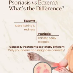 Is it psoriasis or eczema? While both can be itchy, psoriasis plaques are typically thicker and more scaly. This graphic highlights the visual differences, but only a dermatologist can diagnose your condition correctly as the causes and treatments are completely different.