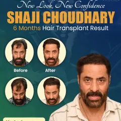 This is actor Shaji Choudhary's 6-month progress. Even at the halfway mark, you can see a significant improvement in density and hairline design, which eliminated his need for hair makeup on set.