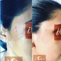A successful non-surgical mole and spot removal using radiofrequency. The 'after' image shows the complete clearance of multiple dark spots from the patient's cheek, achieving a uniform and clear complexion with minimal downtime.