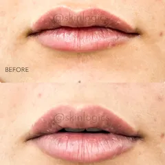 Here is another example of my lip filler work. You can see the subtle increase in volume and improved symmetry, resulting in lips that look naturally plump and well-defined.