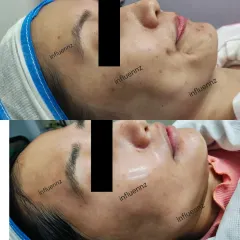 A clear example of skin rejuvenation. The 'before' shows uneven texture and dullness, while the 'after' reveals a much smoother, hydrated, and glowing complexion after a series of customized treatments.