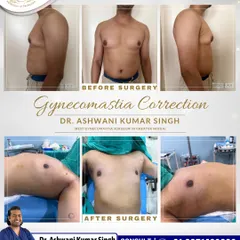 This patient's transformation through Gynecomastia surgery shows a significant change in chest contour. I carefully removed excess glandular tissue and fat to create a flatter, more masculine chest. Notice the improved definition from both the front and side profiles.